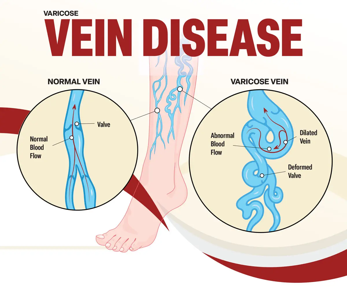 Varicose Vein Disease