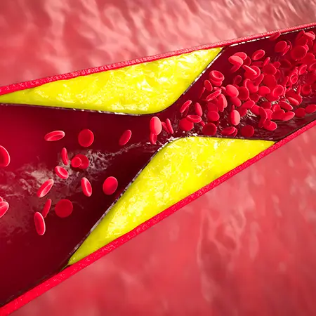 Peripheral Artery Disease