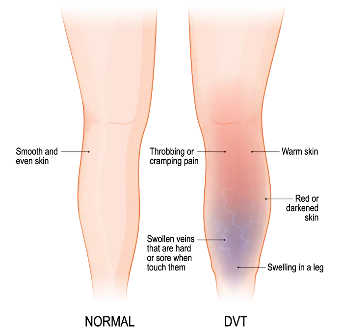Deep Vein Thrombosis - Cardiovascular Experts